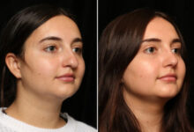 عمل زیبایی بینی