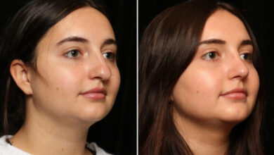 عمل زیبایی بینی