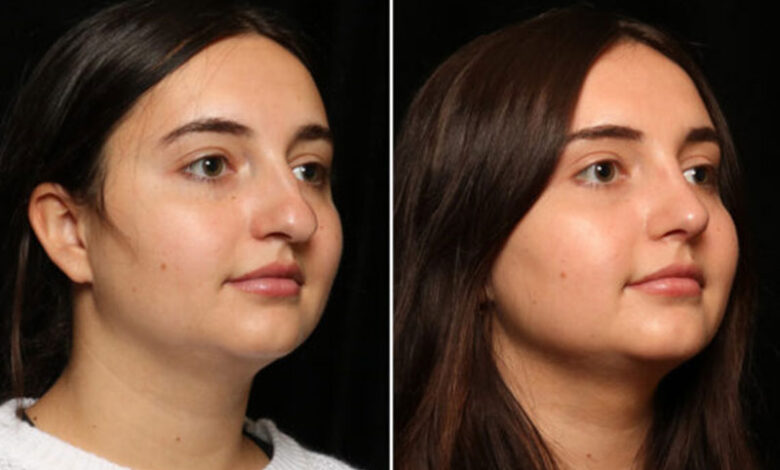 عمل زیبایی بینی